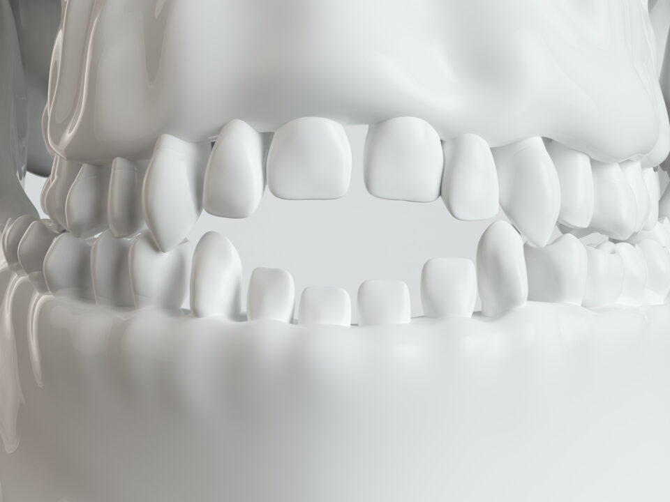 invisible-dental-braces