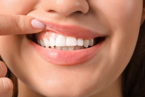 teeth whitening treatment dubai